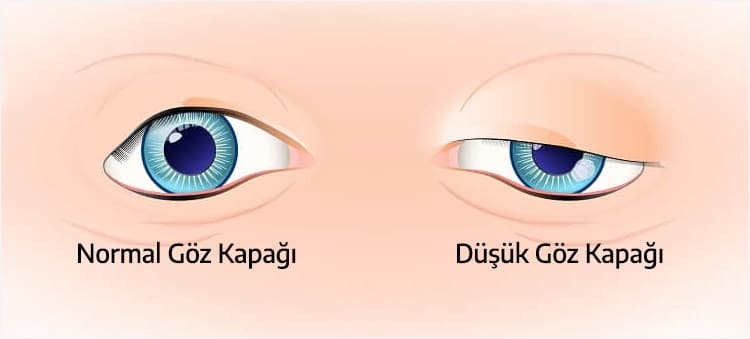 goz-kapagi-dusuklugu-ameliyati